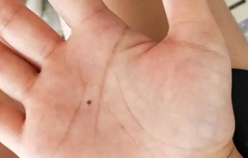 右手心有痣的男人好不好 男人右手手心长痣代表什么